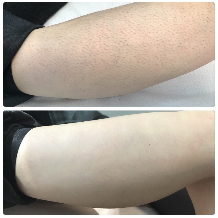 Black and coarse hair: laser hair removal results